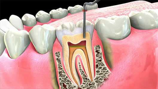 endodonzia brescia